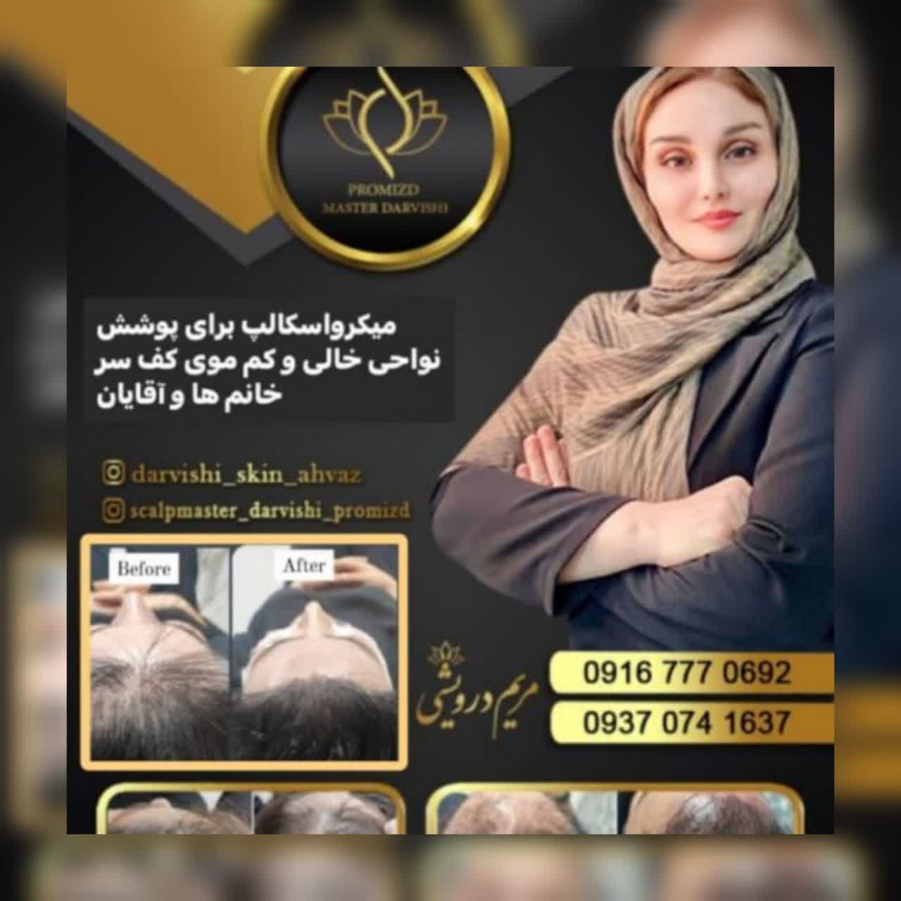 میکرواسکالپ سر - تصویر 1
