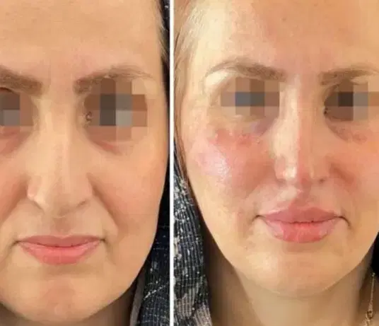 آفر تزرریقات ژل و بوتاکس فشیال - تصویر 7