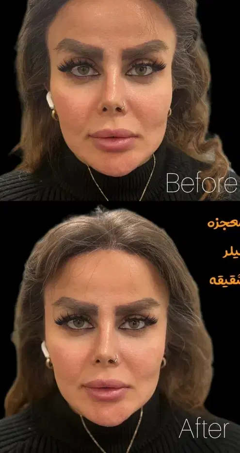 آفر تزرریقات ژل و بوتاکس فشیال - تصویر 9