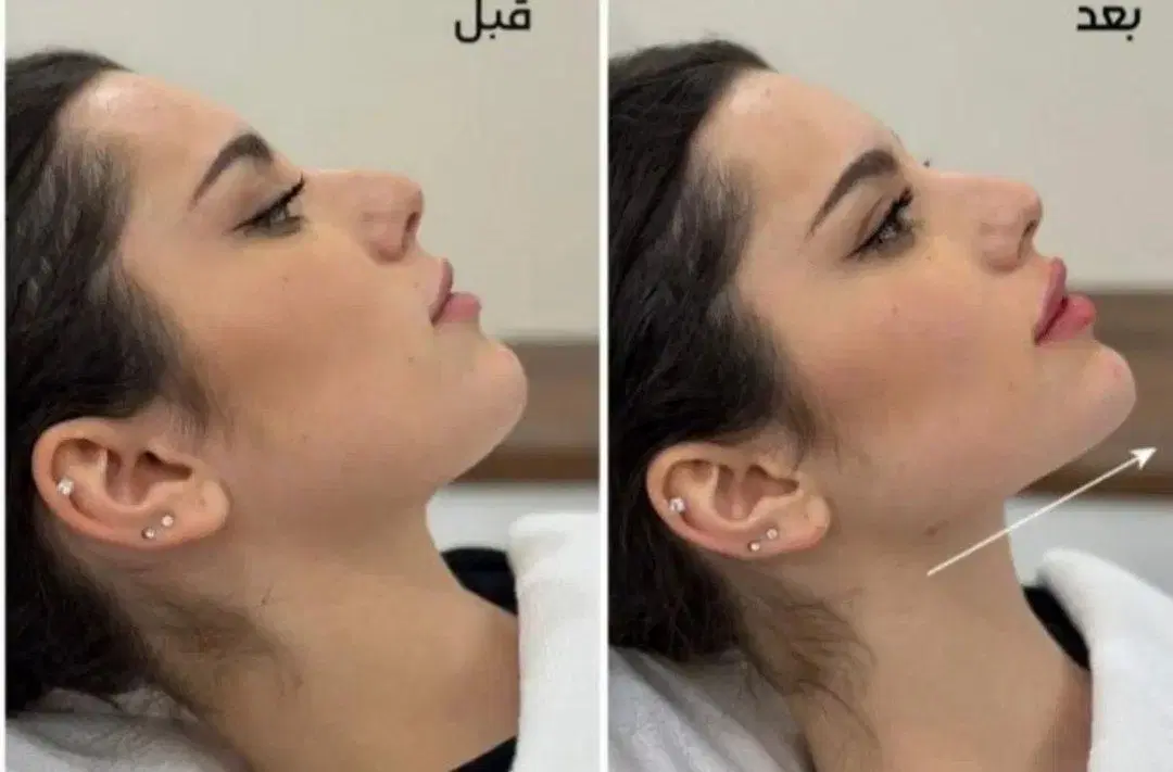 ژل650 و بوتاکس 900و پی ار پی - تصویر 3