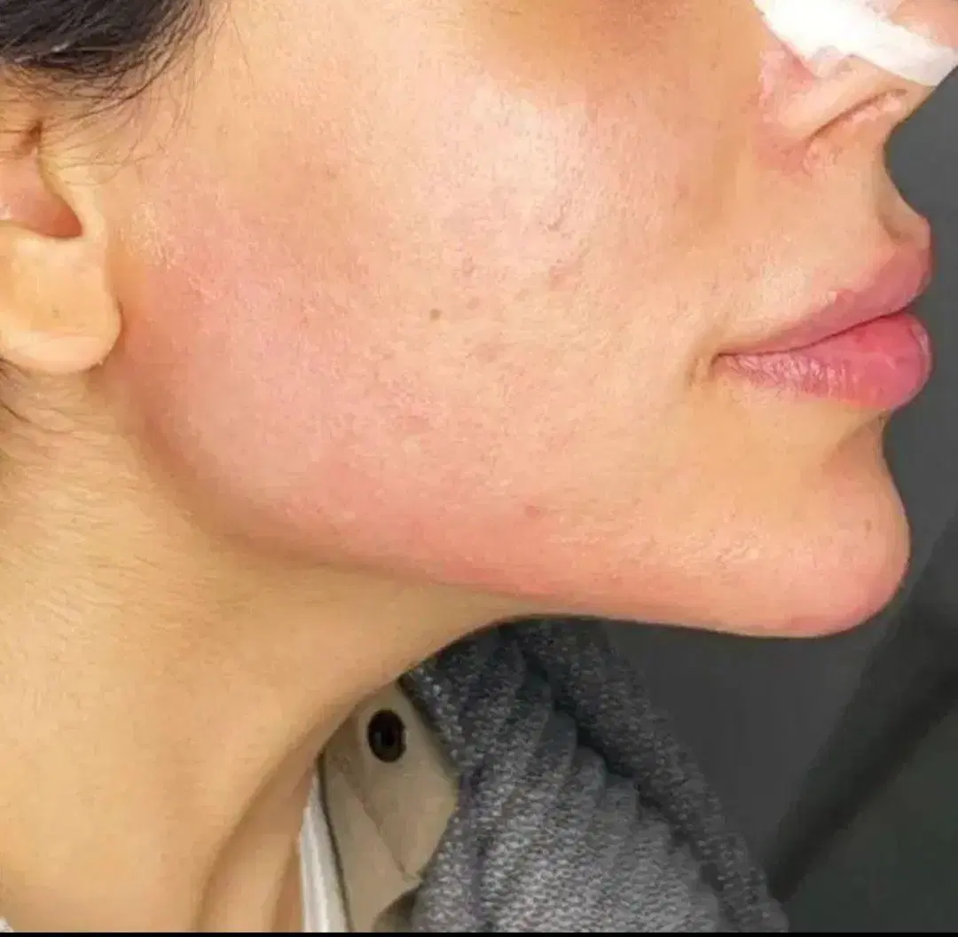 ژل650 و بوتاکس 900و پی ار پی - تصویر 4