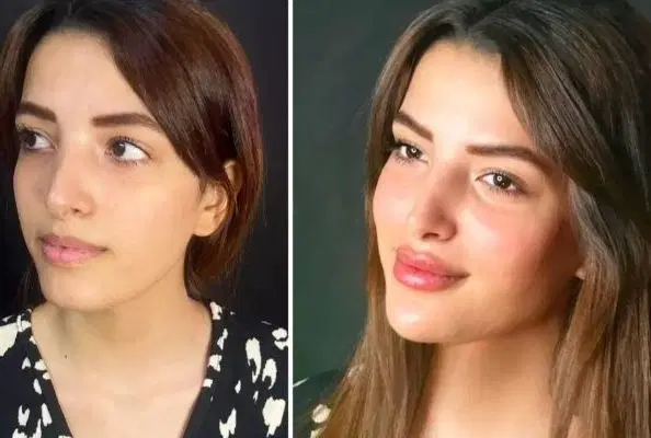 ژل650 و بوتاکس 900و پی ار پی - تصویر 5