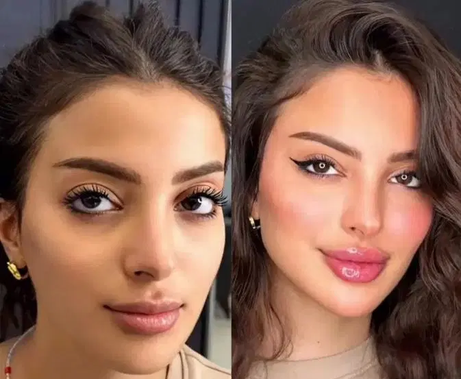 ژل650 و بوتاکس 900و پی ار پی - تصویر 6