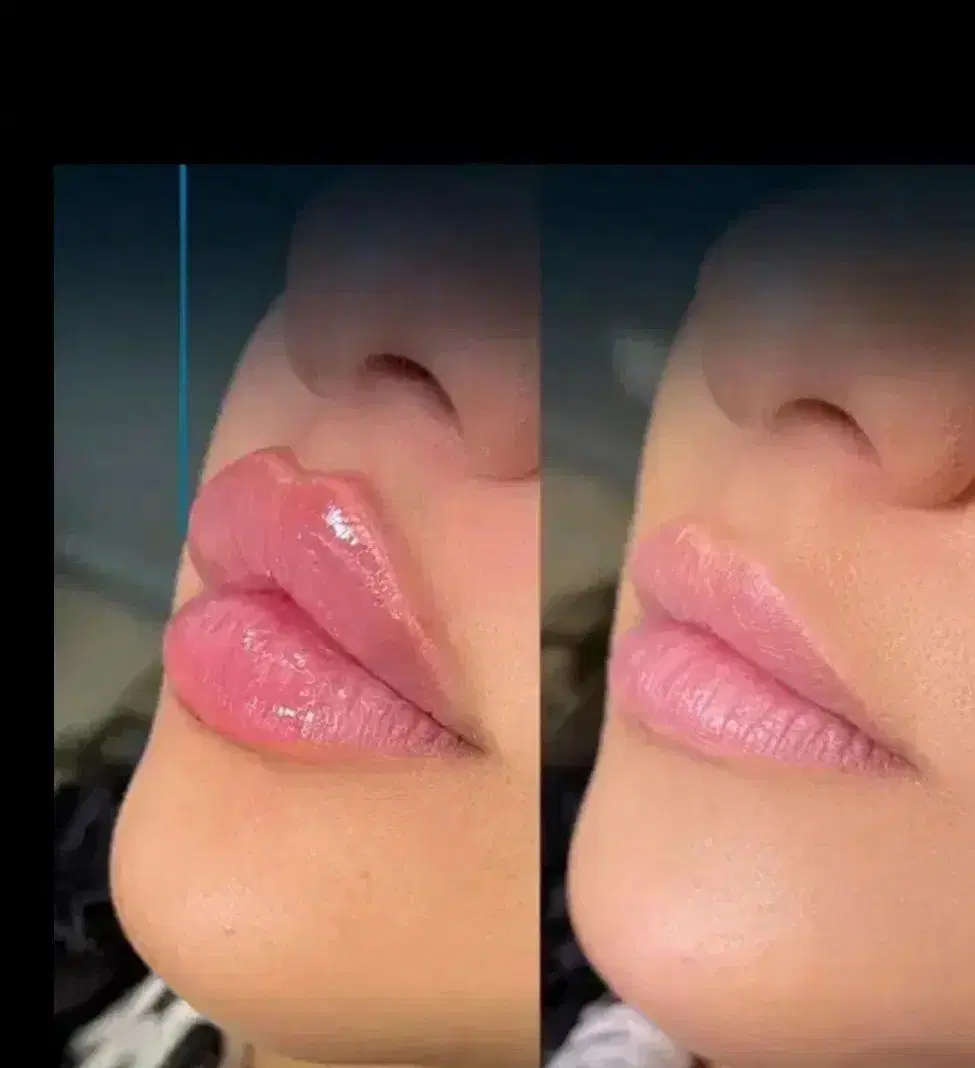 ژل650 و بوتاکس 900و پی ار پی - تصویر 9